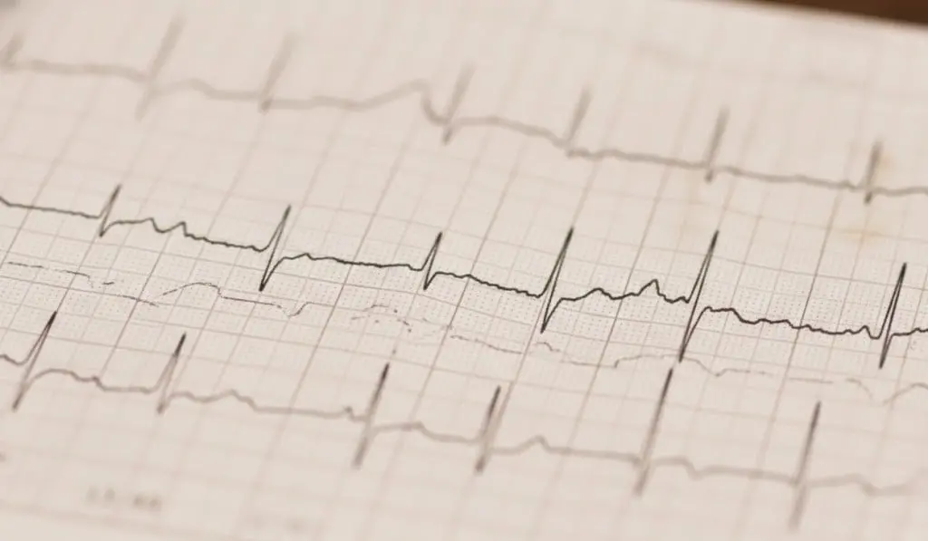 Result graph from Holter monitor
