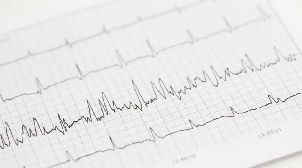 Result graph from Holter monitor
