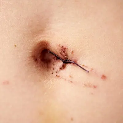 Stomach stitches removal