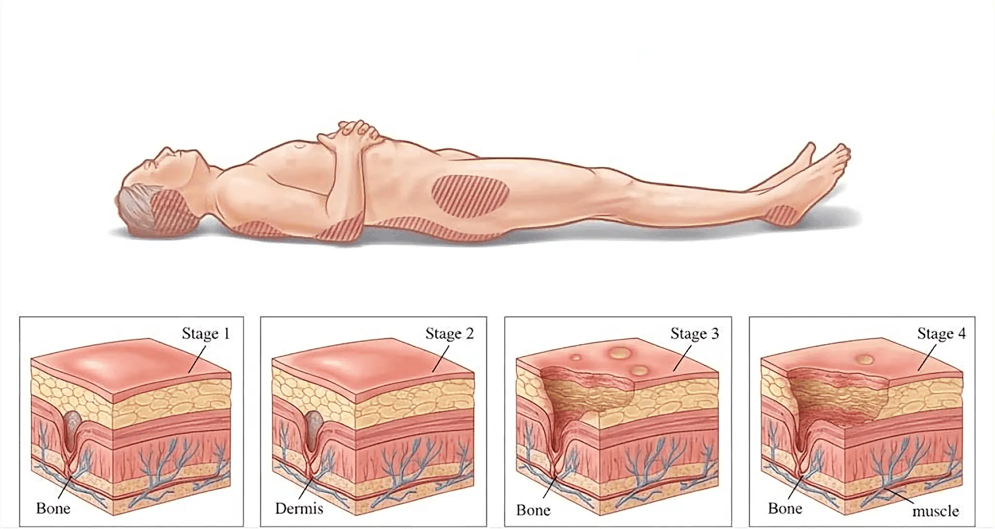 stages1