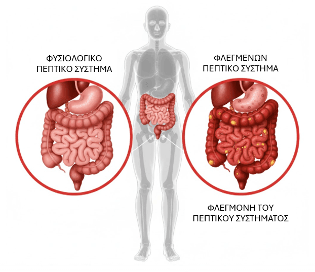 Περιτονίτιδα